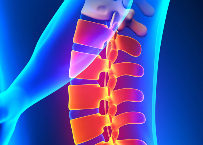 Osteoporosis & Your Spine - Stridewell